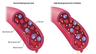 Picture2 | roma hospital Cross-section of an artery showing normal blood glucose with evenly distributed glucose molecules; on the right, high glucose level in diabetes with many glucose molecules visible.