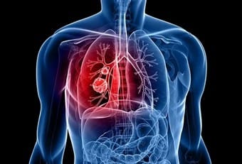 Picture5 | roma hospital Medical illustration of a translucent torso showing lungs and heart, with red emphasis on chest blood vessels.